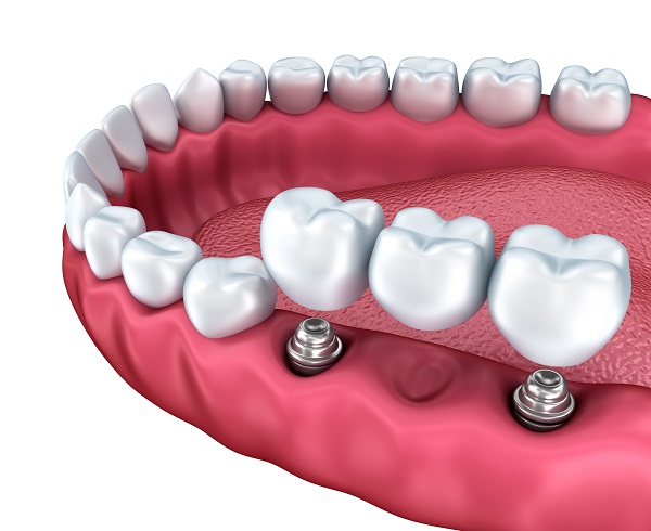 Can I Replace My Dentures With Dental Implants?