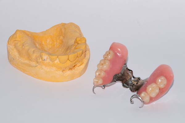 When Does A Dentist Use Partial Dentures To Replace Missing Teeth?