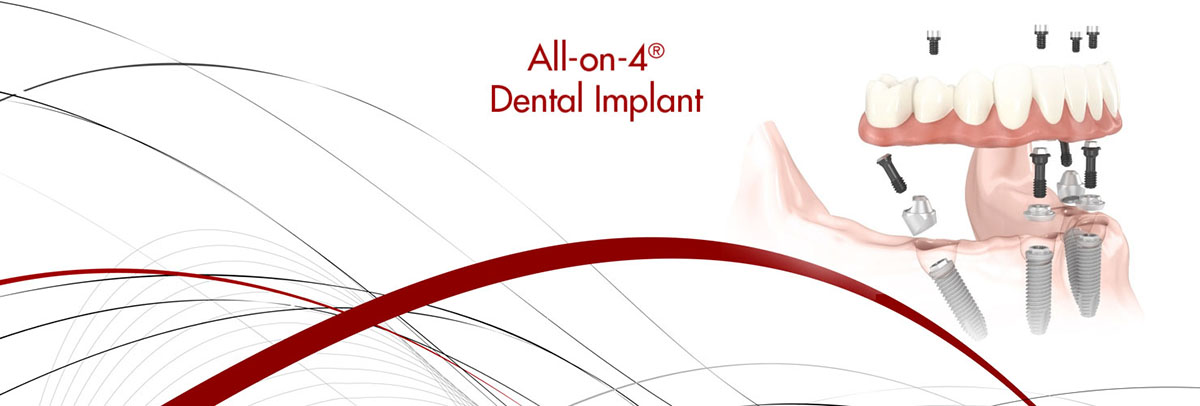 Flushing All-on-4 Dental Implants