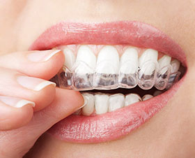 Flushing Alternative to Braces for Teens