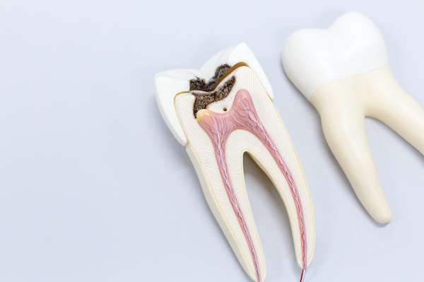 Ask a General Dentist: Is a Tooth Dead After a Root Canal from Queens Family Dental in Flushing, NY