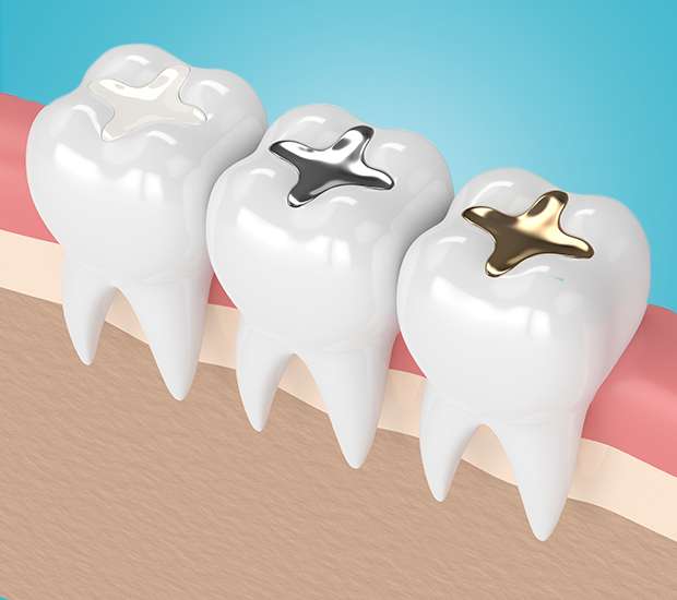 Flushing Composite Fillings