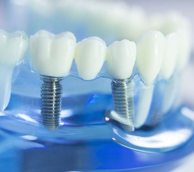 Flushing Dental Implants