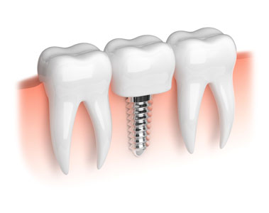 Implant Restoration