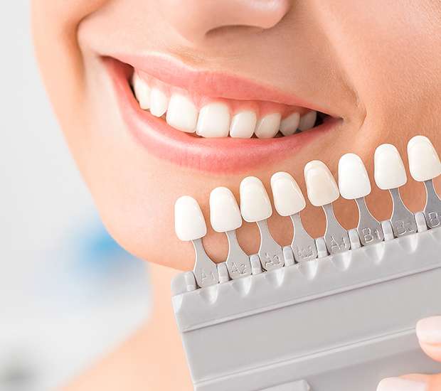 Flushing Dental Veneers and Dental Laminates