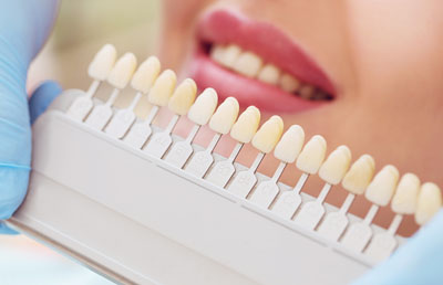 Dental Veneers