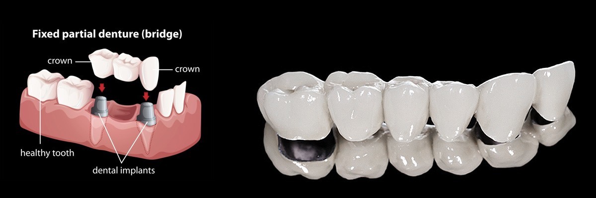 Flushing Dentures