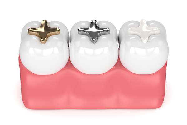 A General Dentist Discusses Different Filling Options from Queens Family Dental in Flushing, NY