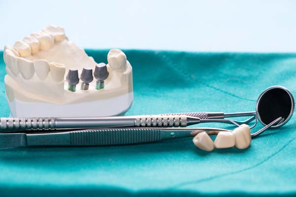 Common Questions About Implant Supported Dentures
