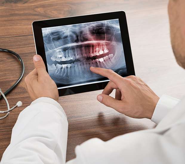 Flushing Types of Dental Root Fractures