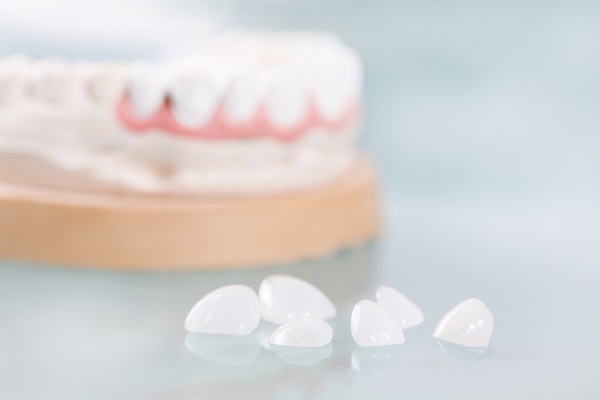 Cosmetic Dentistry: Longevity Of Dental Veneers