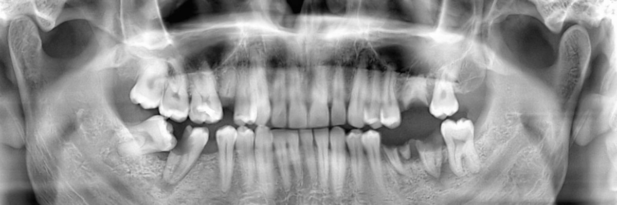 Flushing Wisdom Teeth Extraction